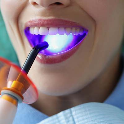 Close up of mouth during cosmetic dental bonding in River Ridge
