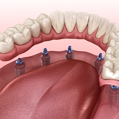 Illustration of implant dentures in River Ridge