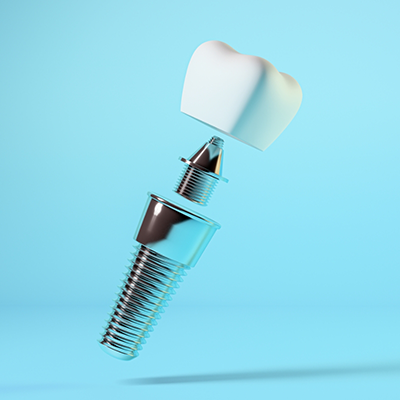 Illustration of dental implant post, abutment, and crown