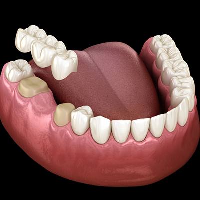 Illustration of dental bridge being attached to lower teeth