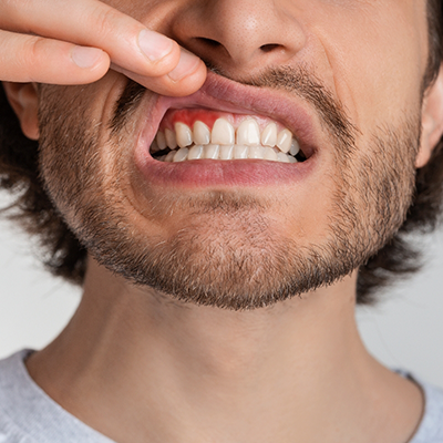 Pulling up lip to show signs of gum disease