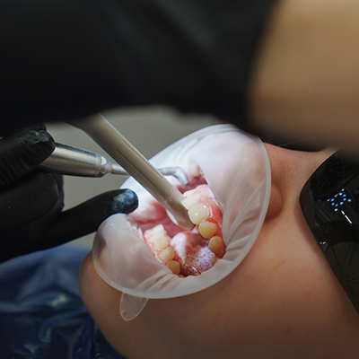 Silver diamine fluoride being applied to child's teeth