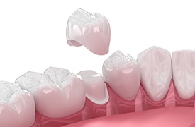 Illustration of a dental crown