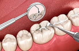 Illustration of dental filling