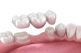 Illustration of dental bridge