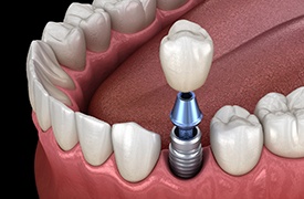 Illustration of dental implant