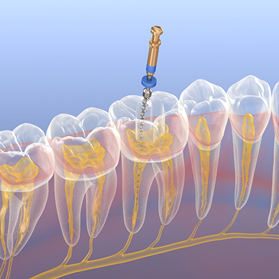 Illustration of a root canal treatment