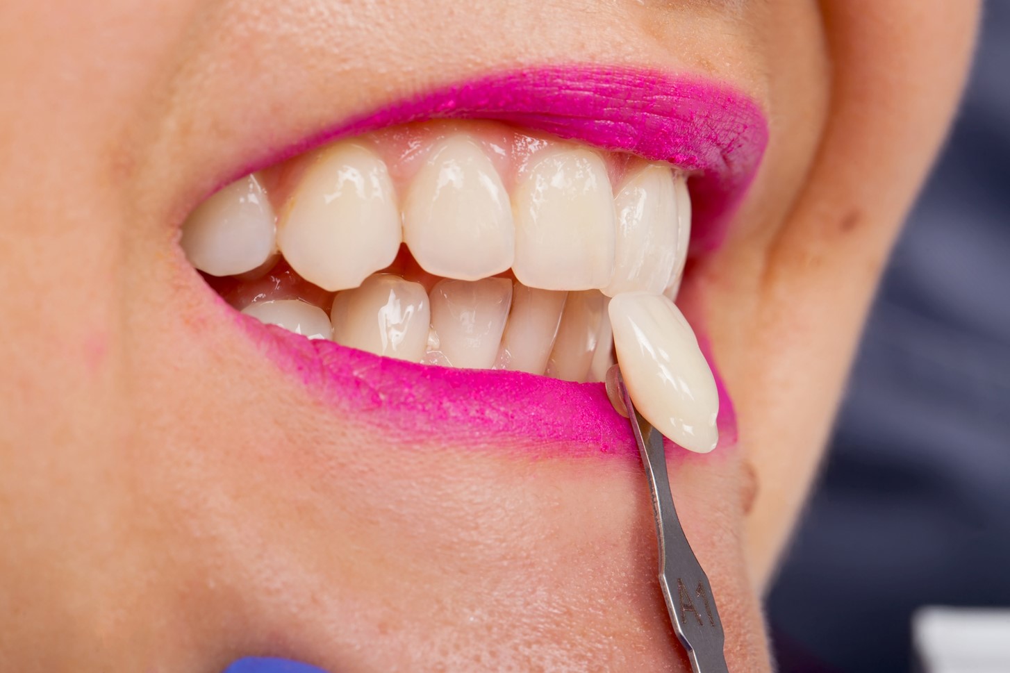 What Are Temporary Veneers and Why Are They Necessary?